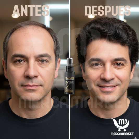 2X1 Aceite capilar con Minoxidil al 5% y Biotina – KORMESIC